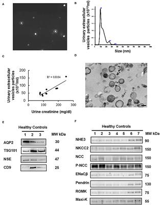 Urinary Extracellular Vesicles for Renal Tubular Transporters Expression in Patients With Gitelman Syndrome